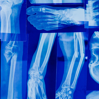 Bone Complex